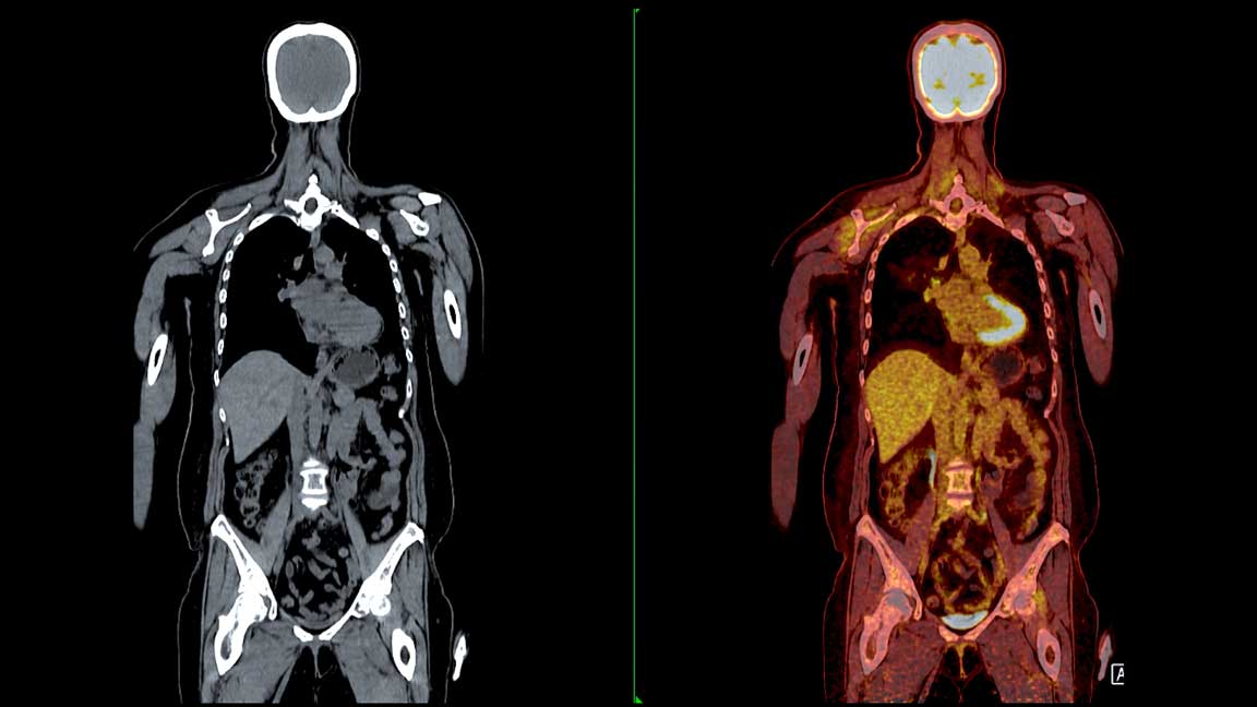 PET/CT